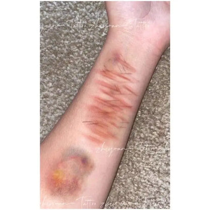 Wound Bruising