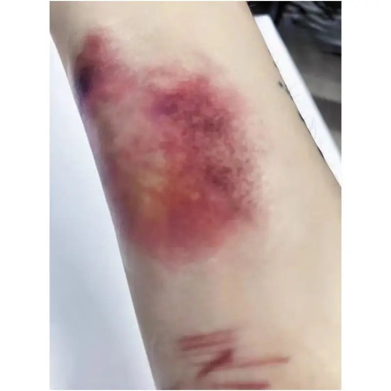 Wound Bruising