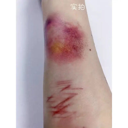 Wound Bruising